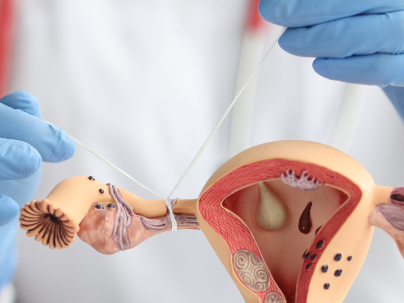 Laparoscopic Myomectomy Surgery Cost In India, Impact Guru