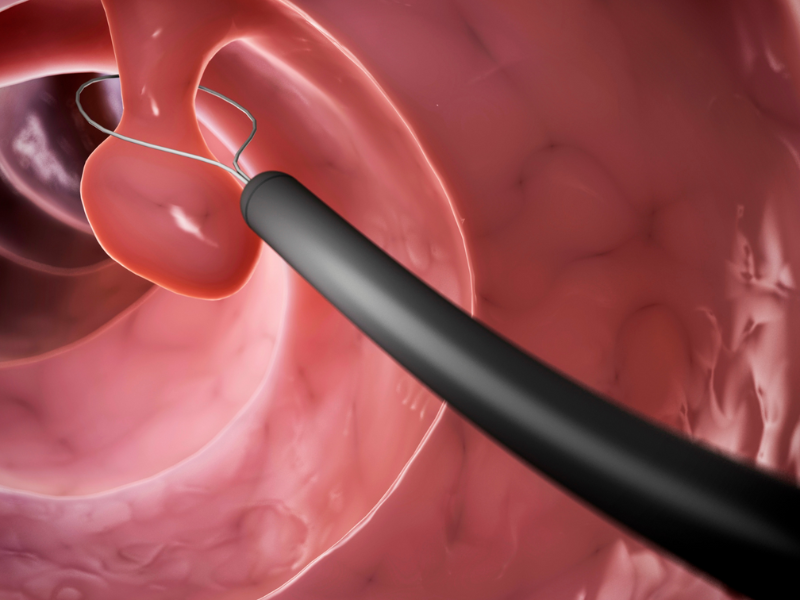 Enteroscopy Cost In India, Impact Guru