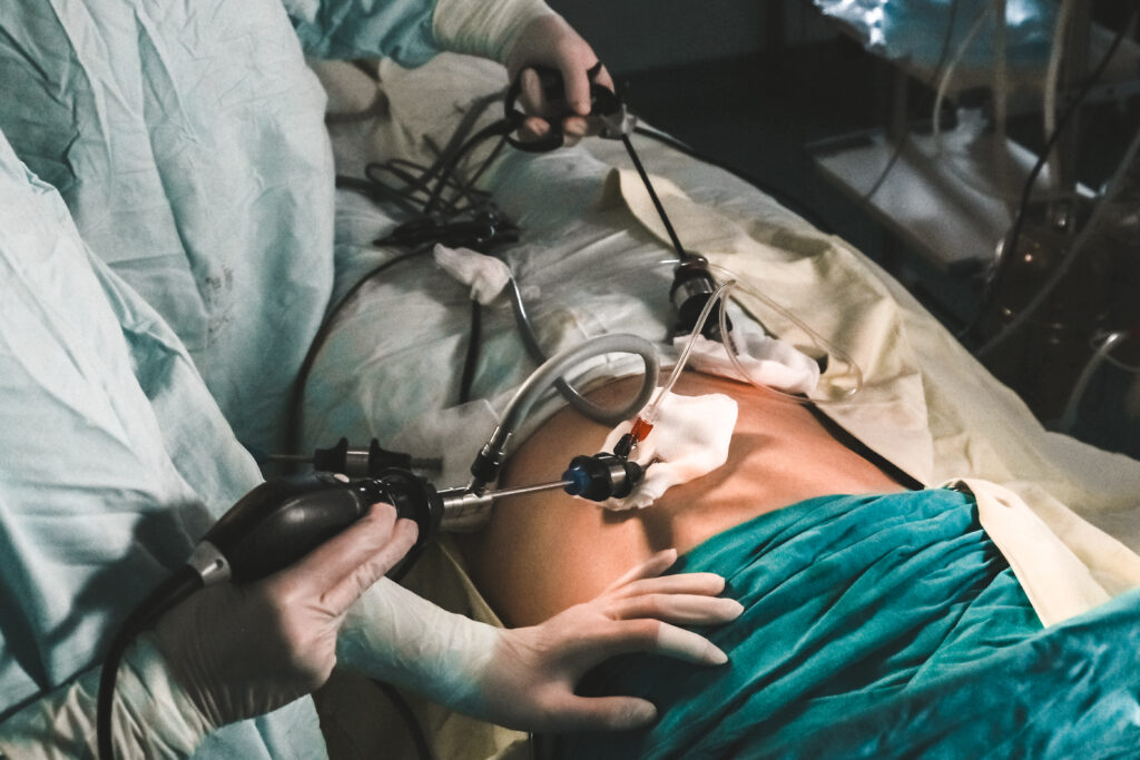 Laparoscopic Cholecystectomy Cost, Impact Guru