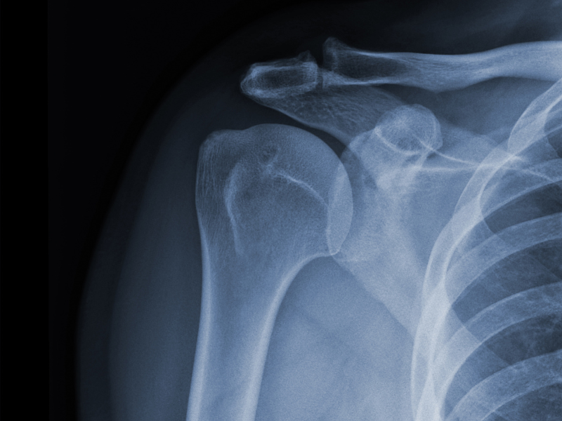 Bone Scan Cost In India, Impact Guru