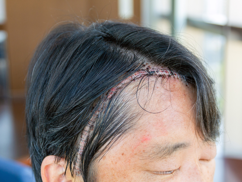 Craniotomy Surgery Cost In India, Impact Guru