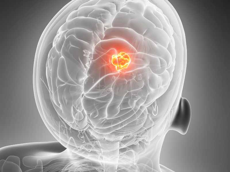 Hypopituitarism Causes