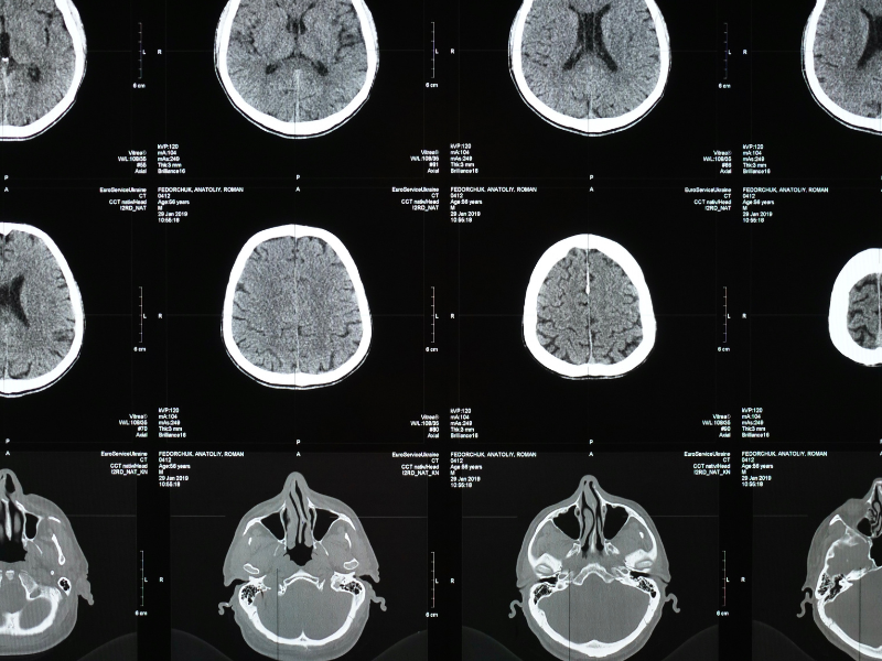 Hypopituitarism Treatment