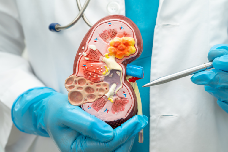 Kidney Stone Removal Cost