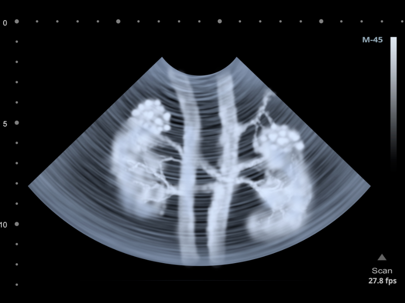 Kidney Stone Scanning Cost
