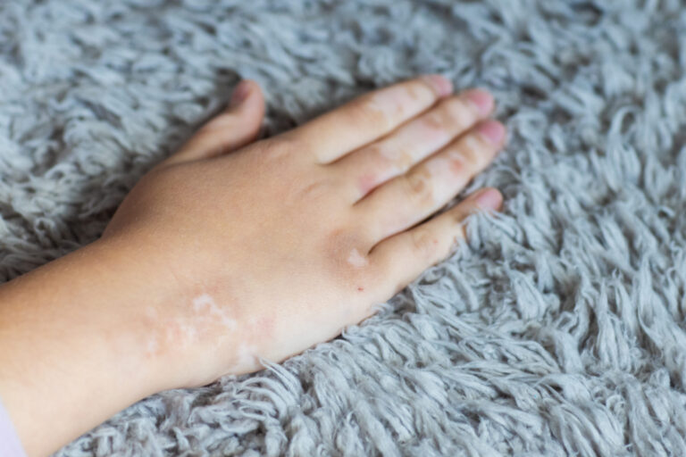 white patches on skin