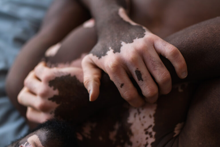 vitiligo stages