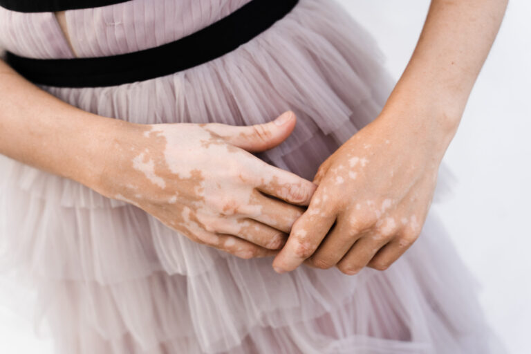 vitiligo treatment